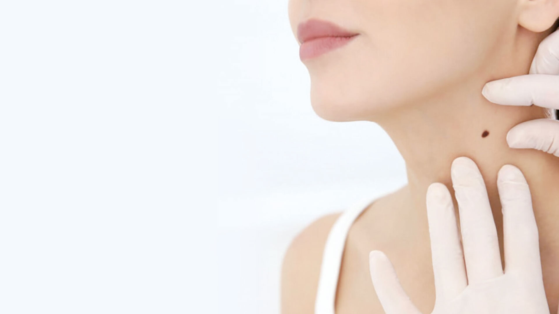 Le grain de beauté et l’été : entre charme et vigilance
