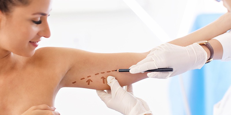 Brachioplastie: l’alliance entre harmonie et liberté